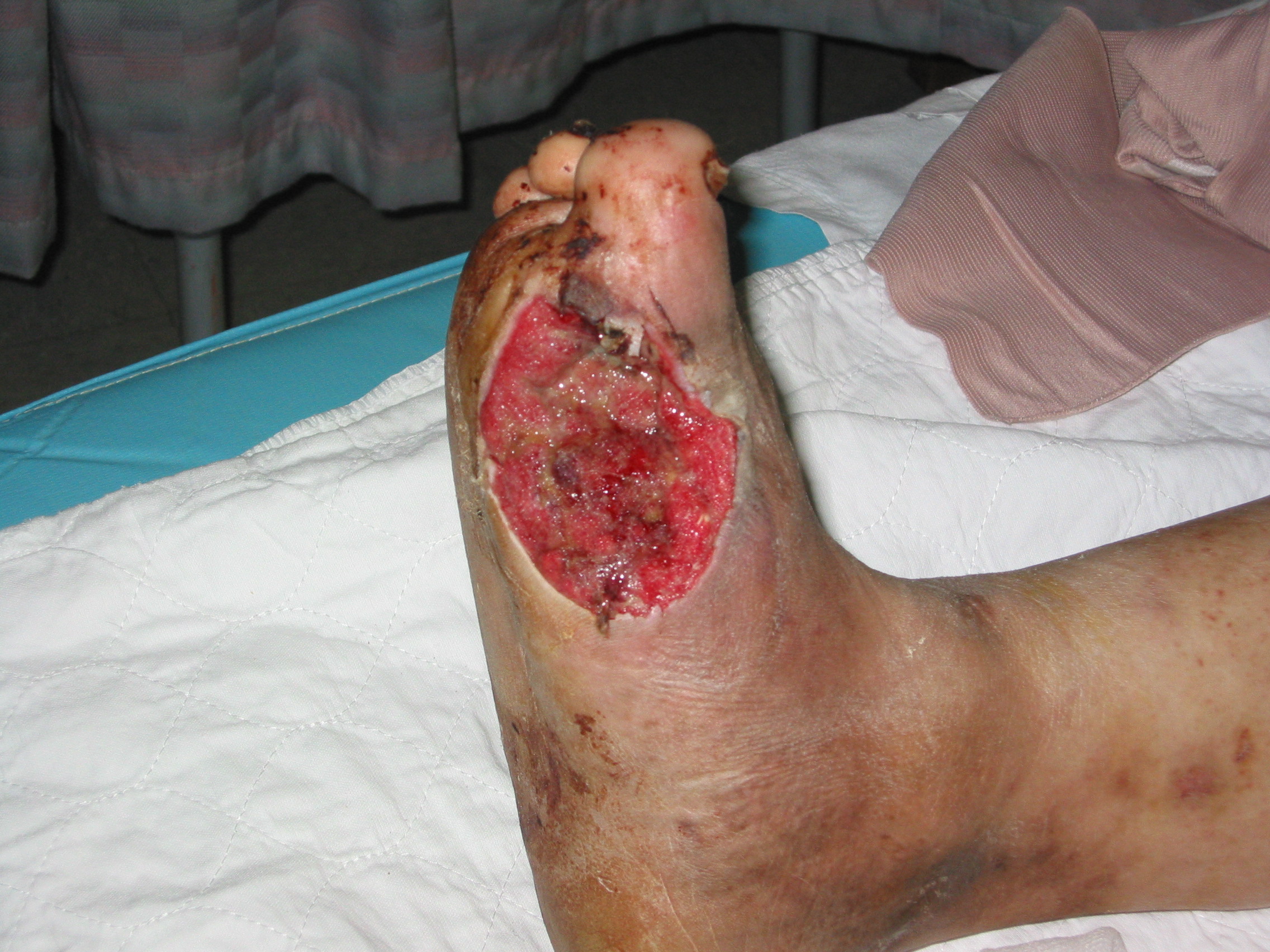 Amniotic graft diabetic foot ulcers - Foot Doctor San Diego / La Jolla