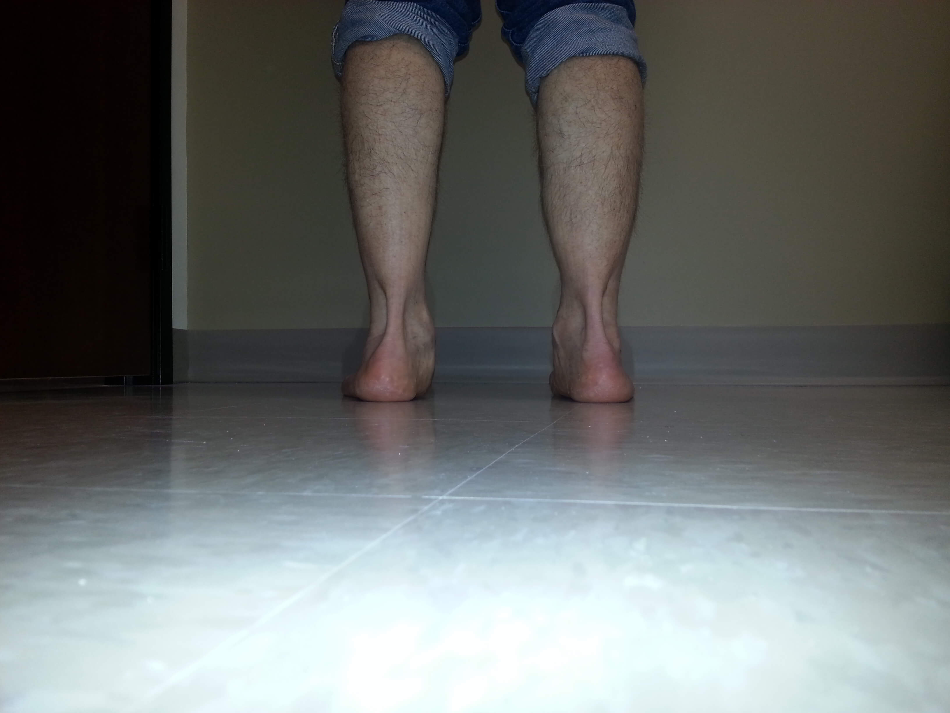 Custom molded orthotics Part 4 Foot Doctor San Diego / La Jolla Podiatrist