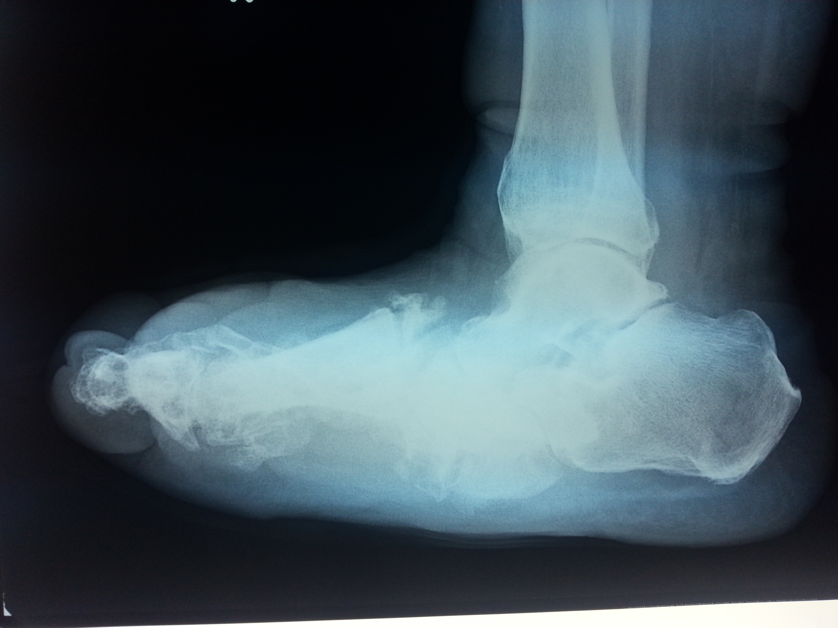Charcot Foot for Pinterest