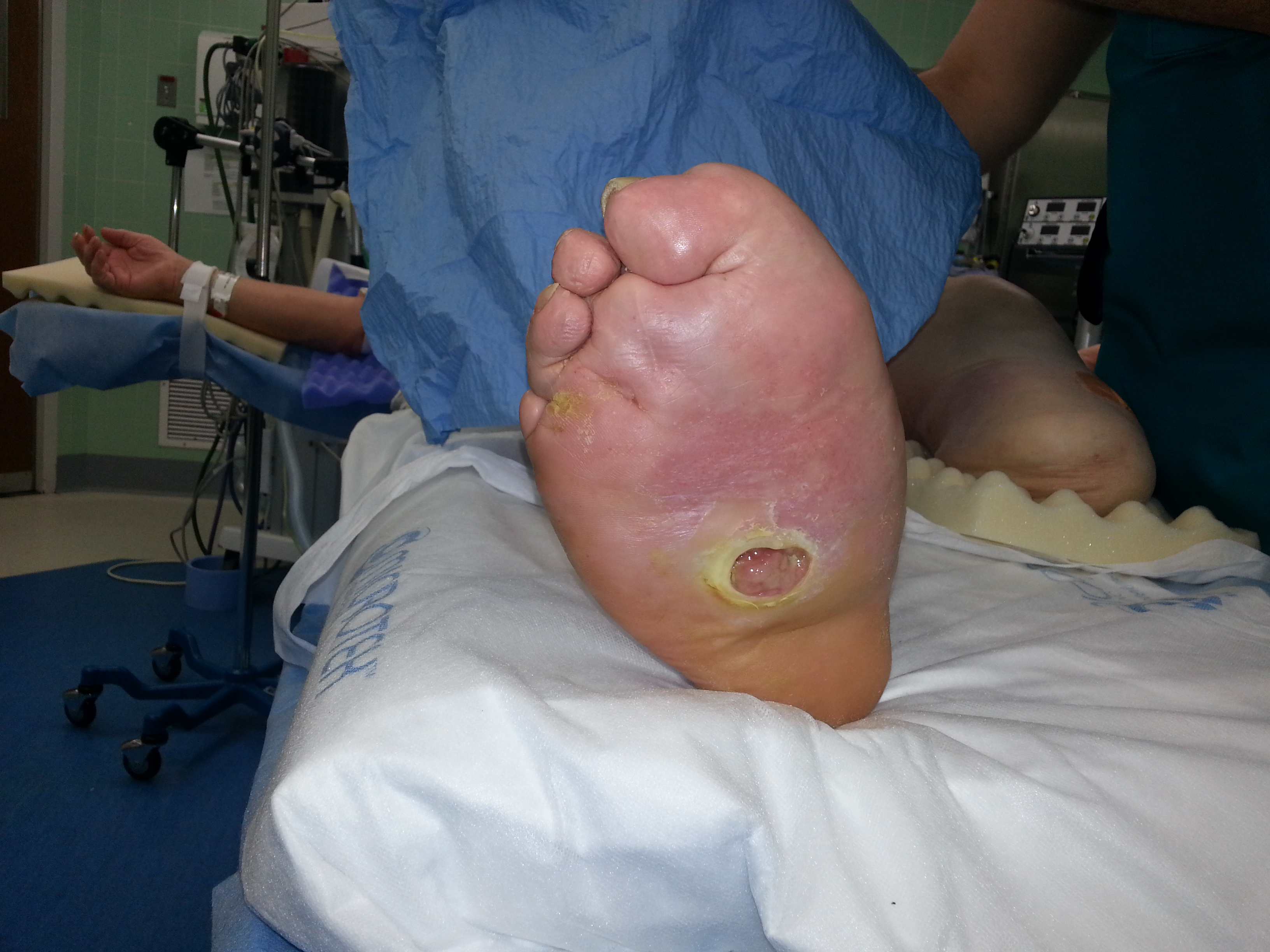 Charcot Foot Reconstruction part 2 - Foot Doctor San Diego / La Jolla ...