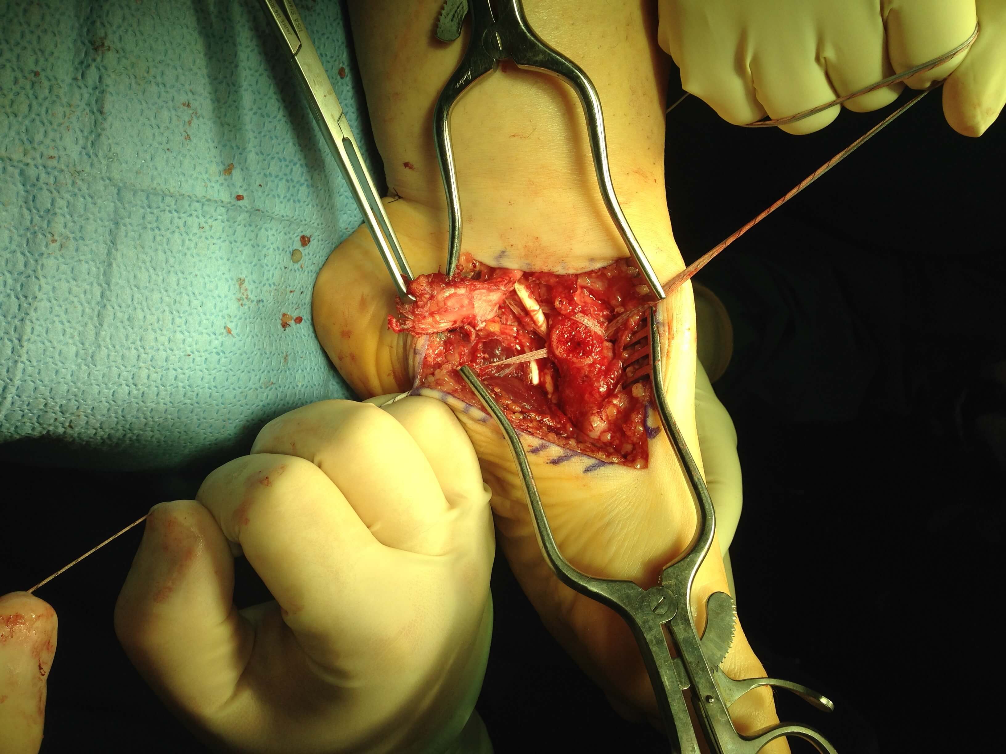FDL Transfer with spring lig repair - Foot Doctor San Diego / La Jolla