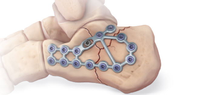 calcaneus fracture orthobullets calcaneus fracture orthobullets