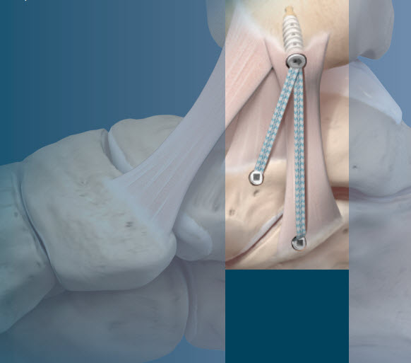 deltoid ligament repair2 Foot Doctor San Diego / La Jolla Podiatrist