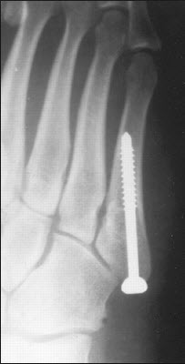jones fracture jones fracture