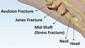jones fracture foot jones fracture foot