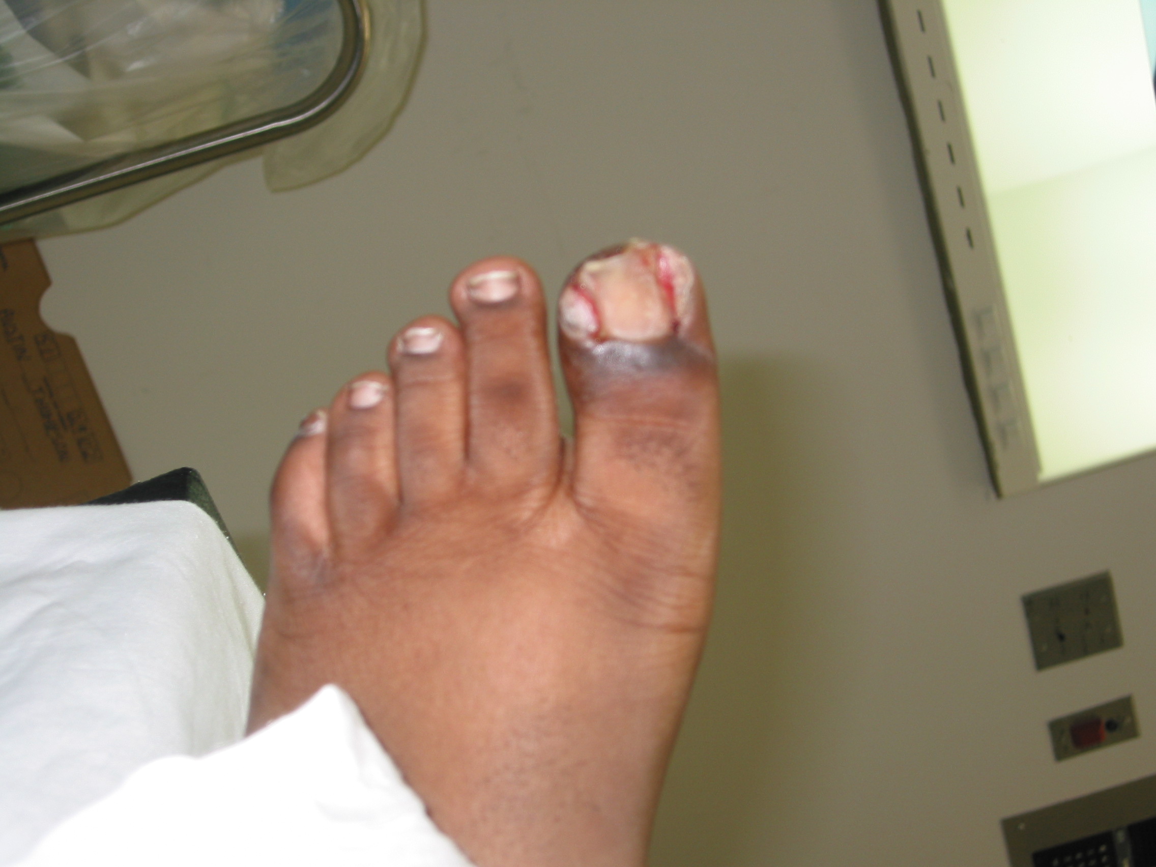 MRSA Foot Infection Foot Doctor San Diego / La Jolla Podiatrist