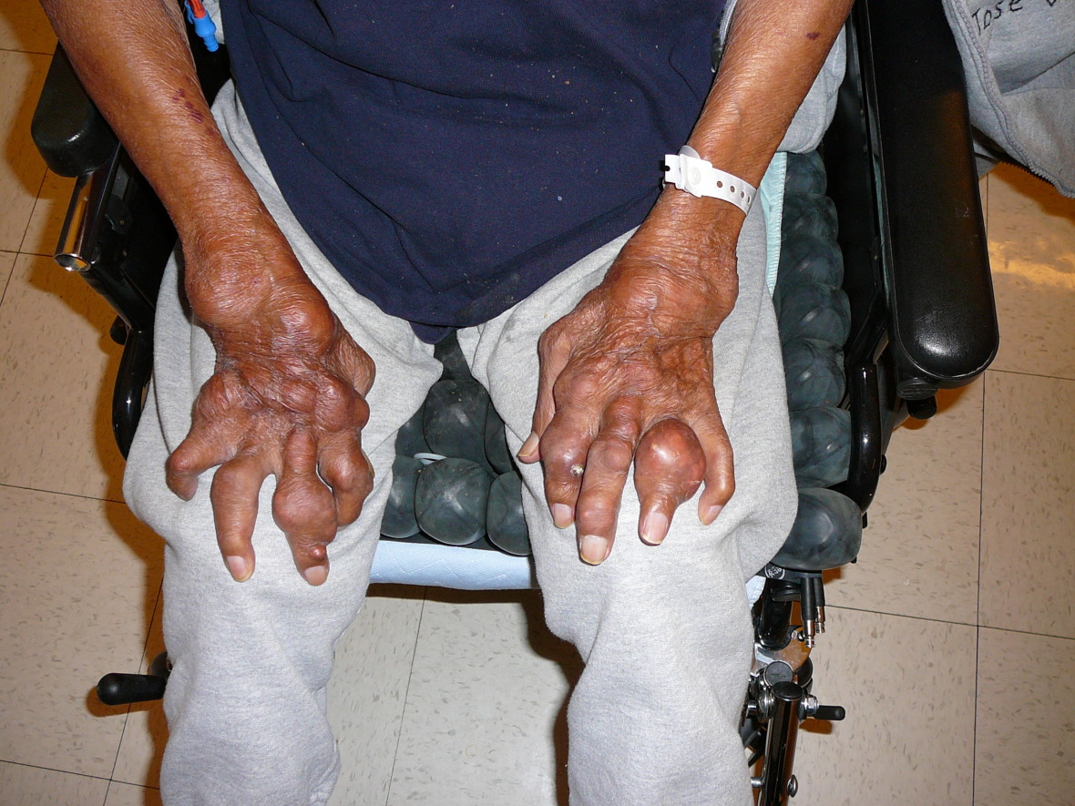 Foot pain from Gout Foot Doctor San Diego / La Jolla Podiatrist