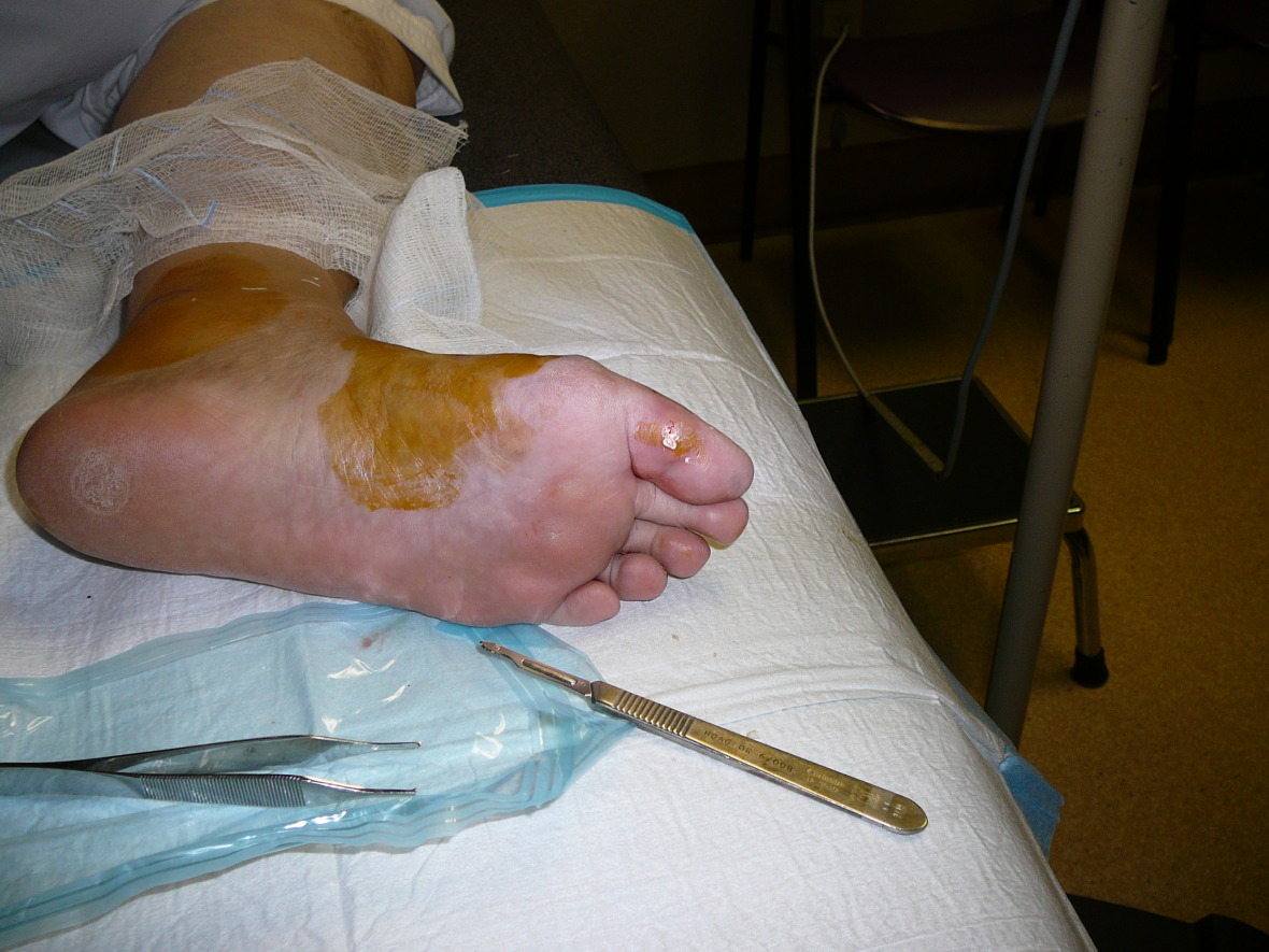 Corns On Feet likewise Nail Fungus Laser Treatment additionally ...
