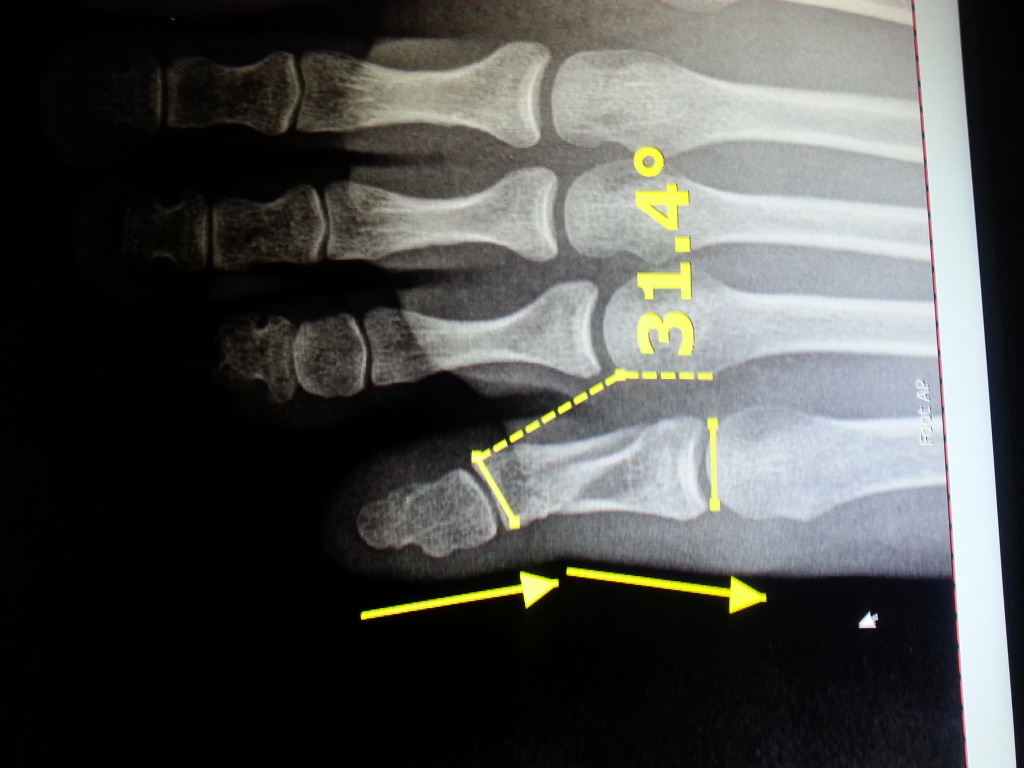 Toe Fracture Foot Doctor San Diego / La Jolla Podiatrist