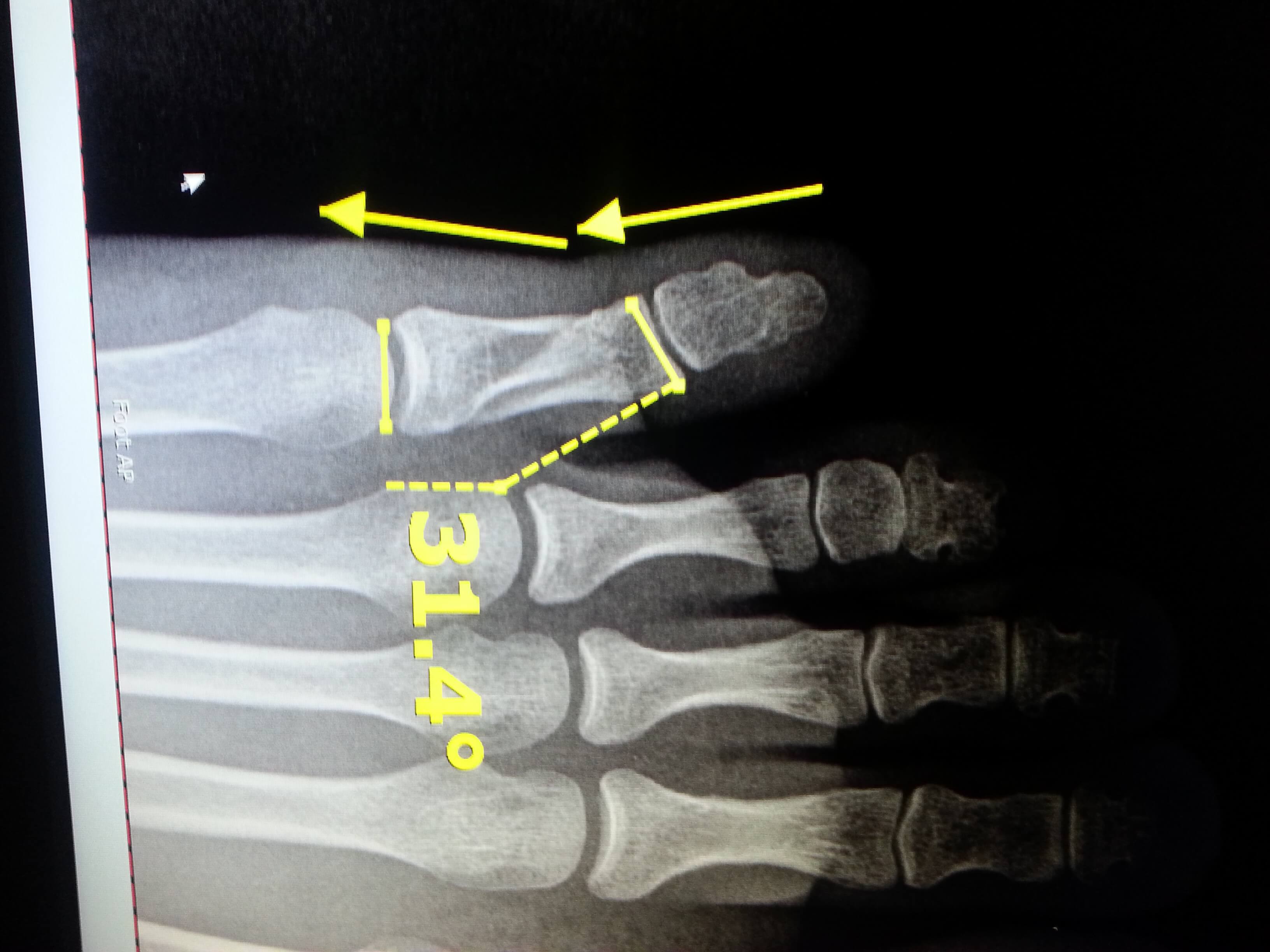 icd 10 code for fracture 5th toe right foot