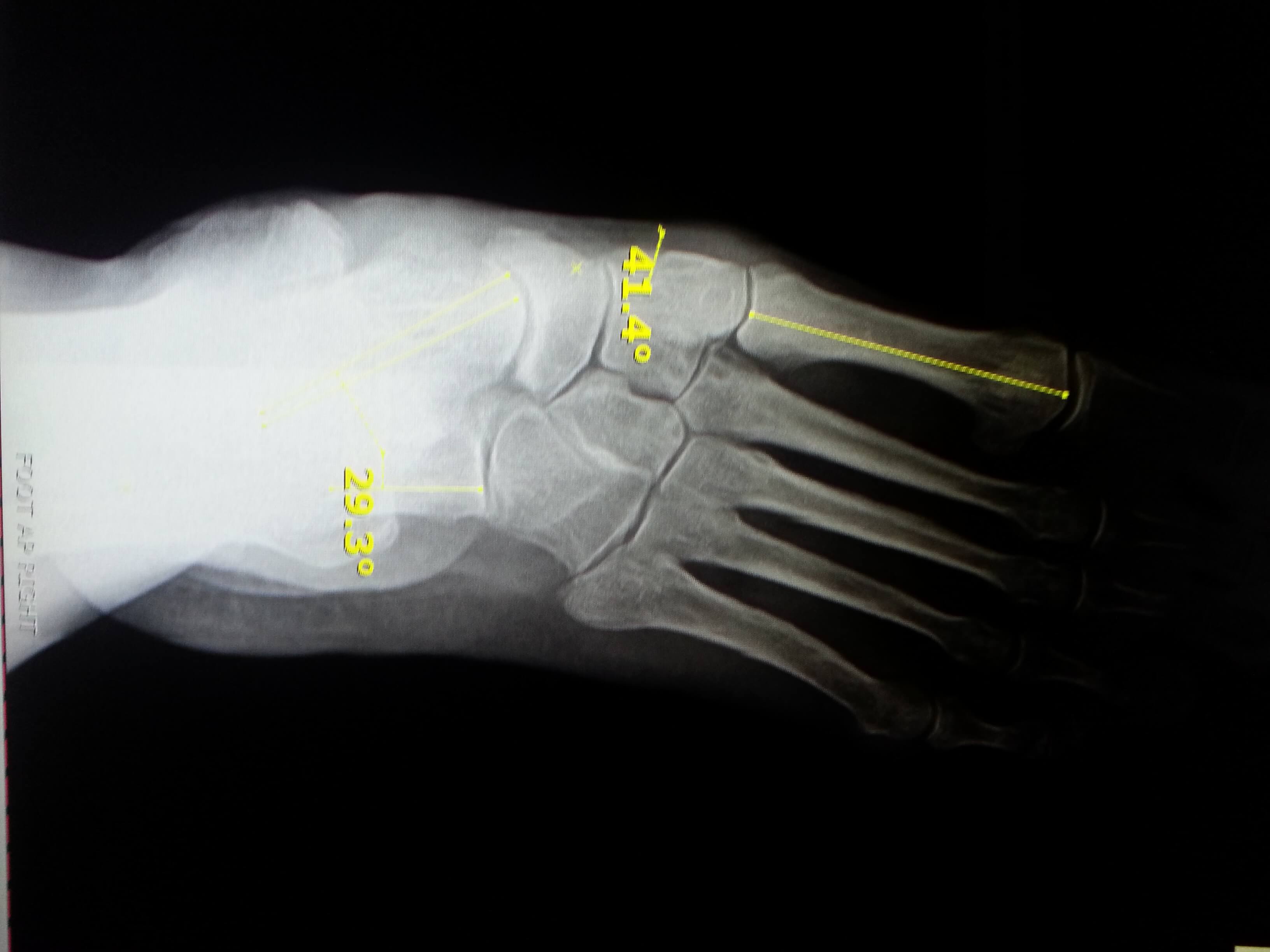 flat foot x rays Foot Doctor San Diego / La Jolla Podiatrist