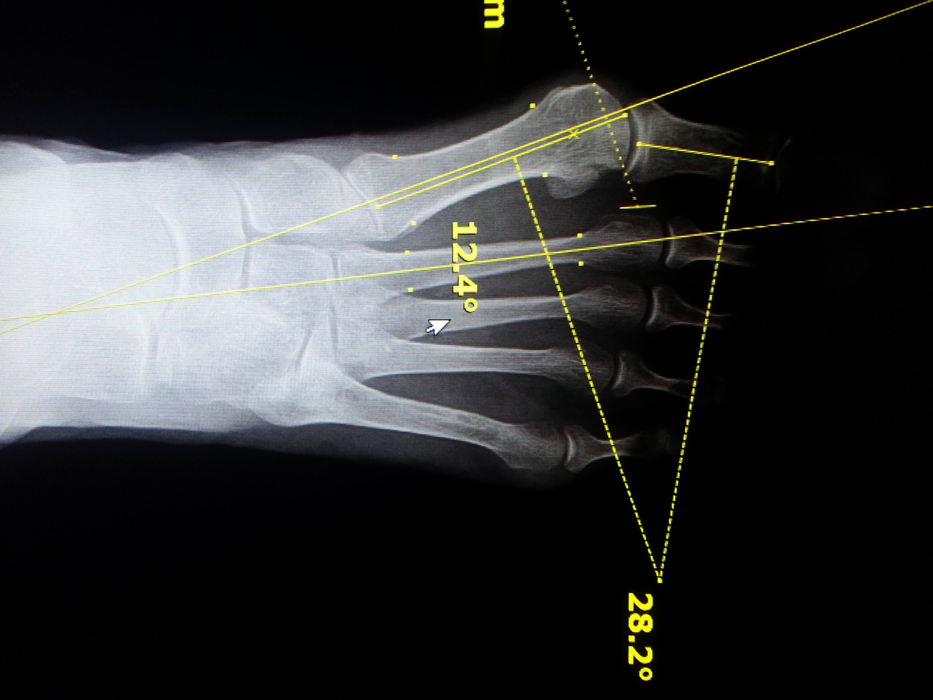 bunion x ray Foot Doctor San Diego / La Jolla Podiatrist