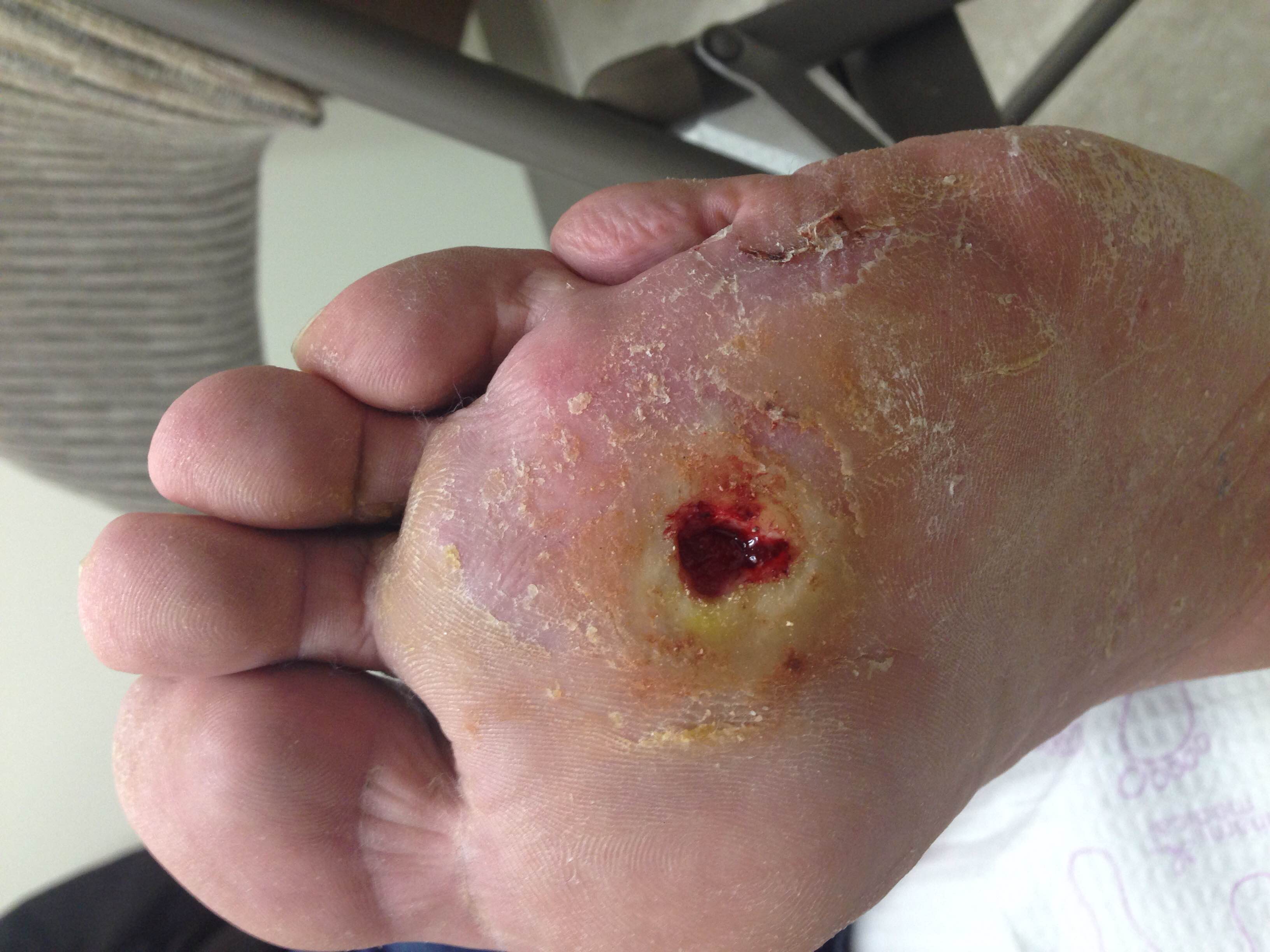 Foot Ulcer Pictures, Images & Photos | Photobucket
