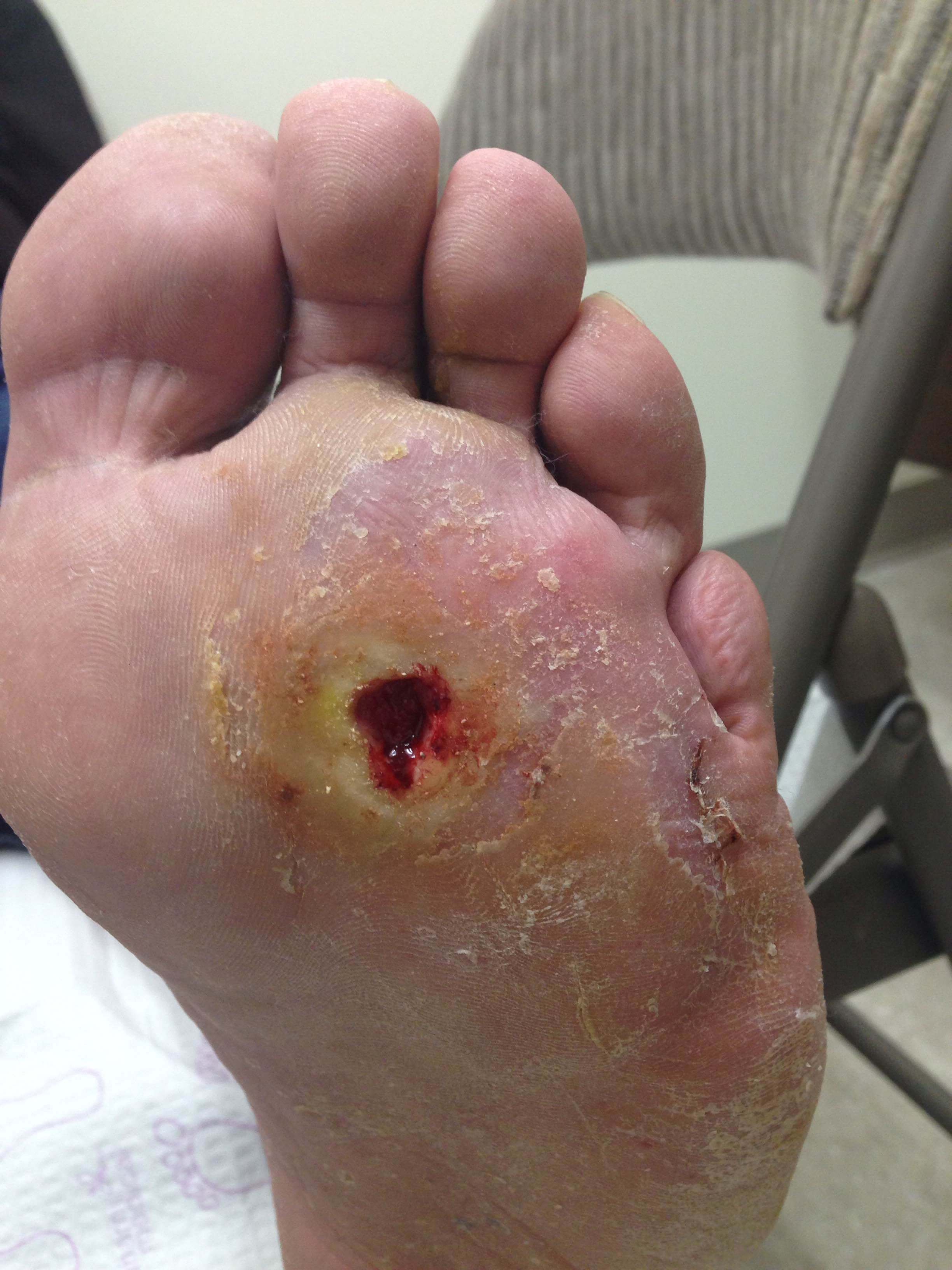 diabetic foot ulcer images