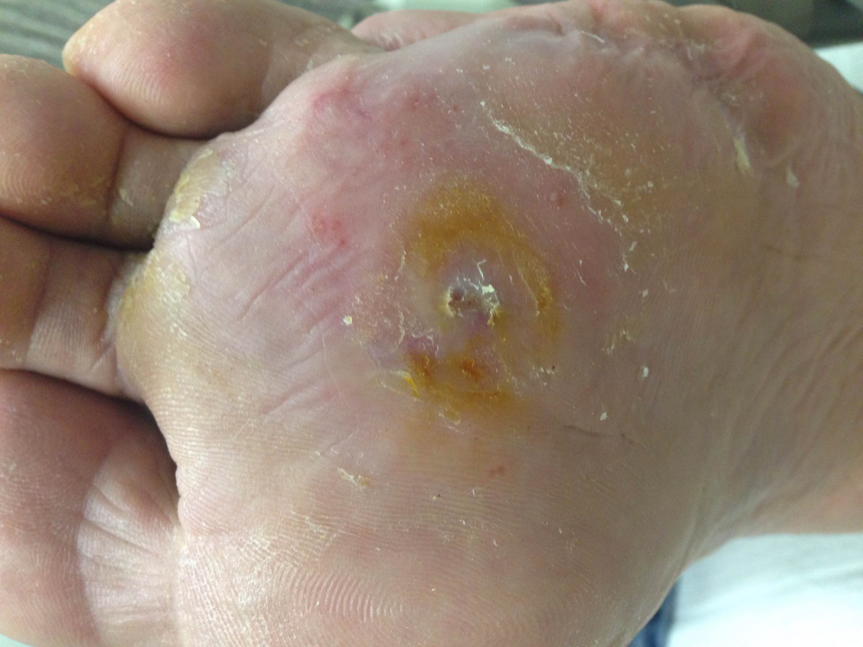 diabetic foot ulceration