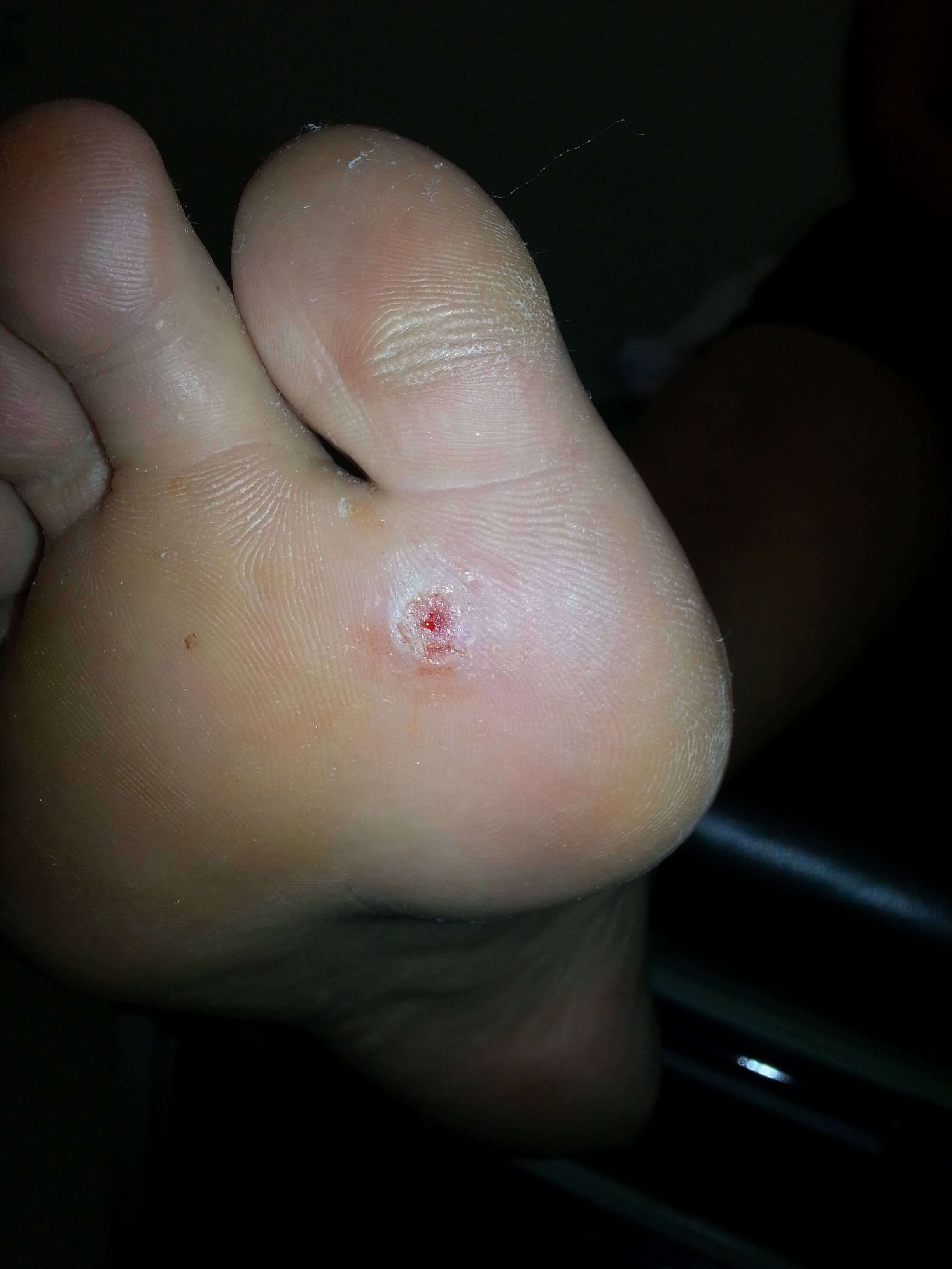 Plantars wart Foot Doctor San Diego / La Jolla Podiatrist