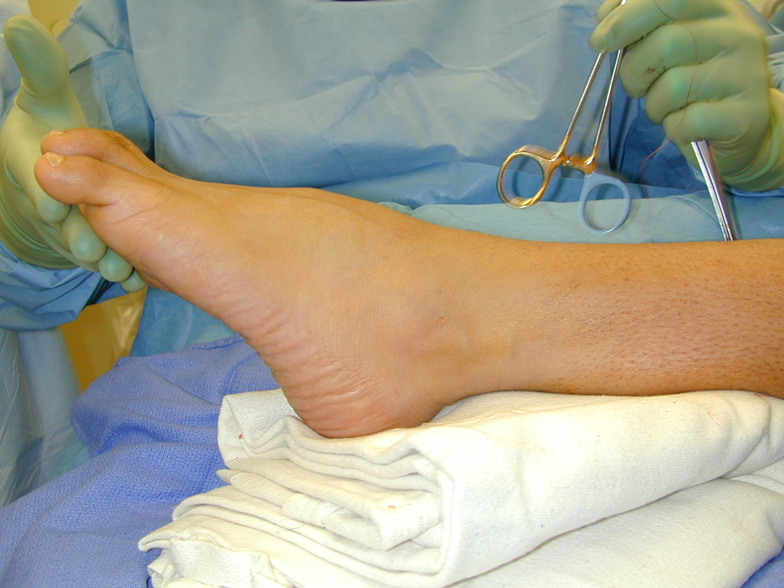 Ankle equinus, Tight achilles , Heel pain, Plantar fasciitis, Heel