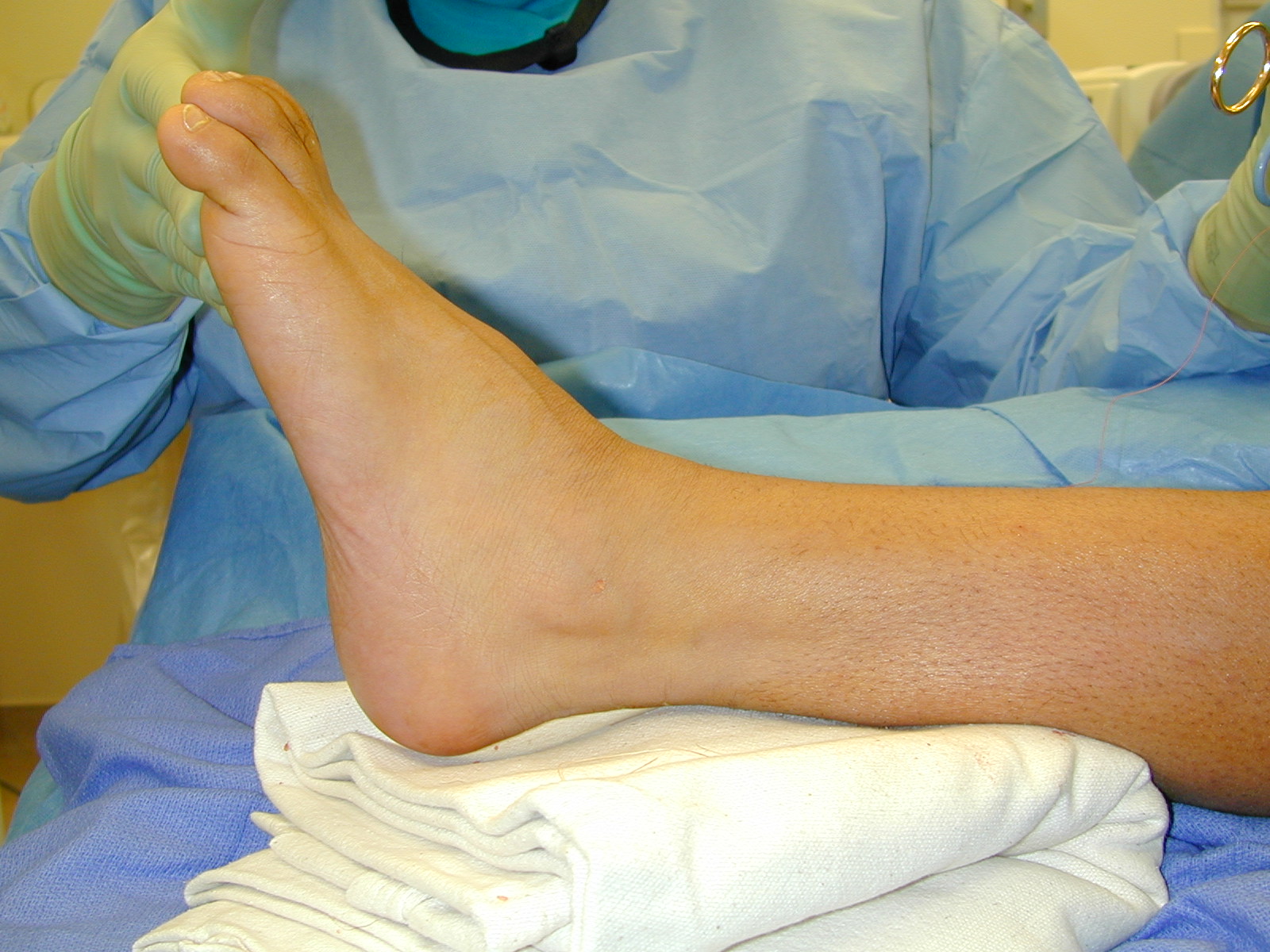 Ankle equinus, Tight achilles , Heel pain, Plantar fasciitis, Heel
