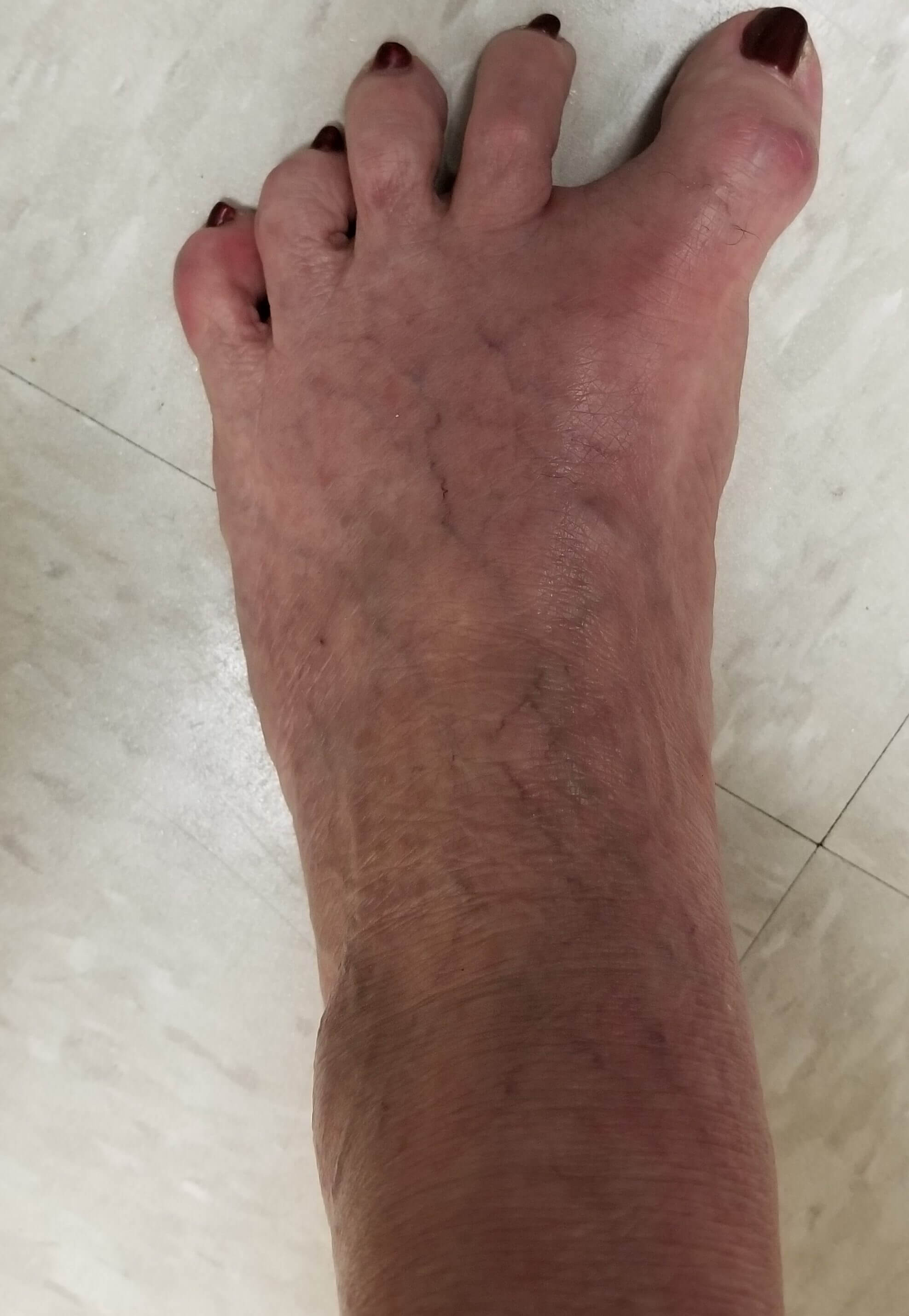 Bunion Surgery Foot Doctor San Diego / La Jolla Podiatrist