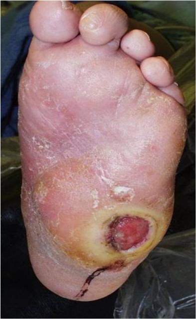 Diabetic Foot Care San Diego - Foot Doctor San Diego / La Jolla Podiatrist