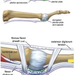 Plantar plate tear - Foot Doctor San Diego / La Jolla Podiatrist