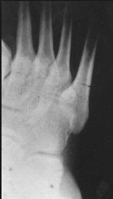 Kevin Durant Jones Fracture - Foot Doctor San Diego / La Jolla Podiatrist