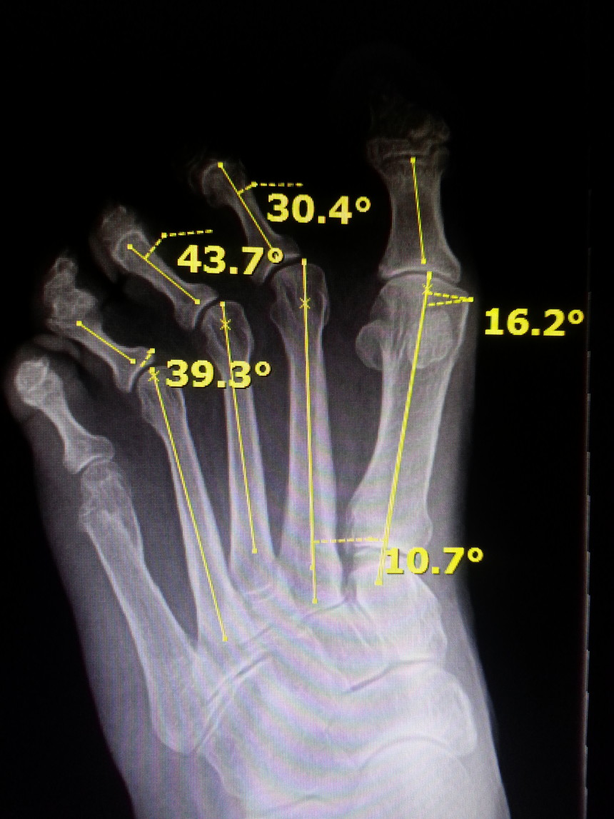 dislocated toes Foot Doctor San Diego / La Jolla Podiatrist