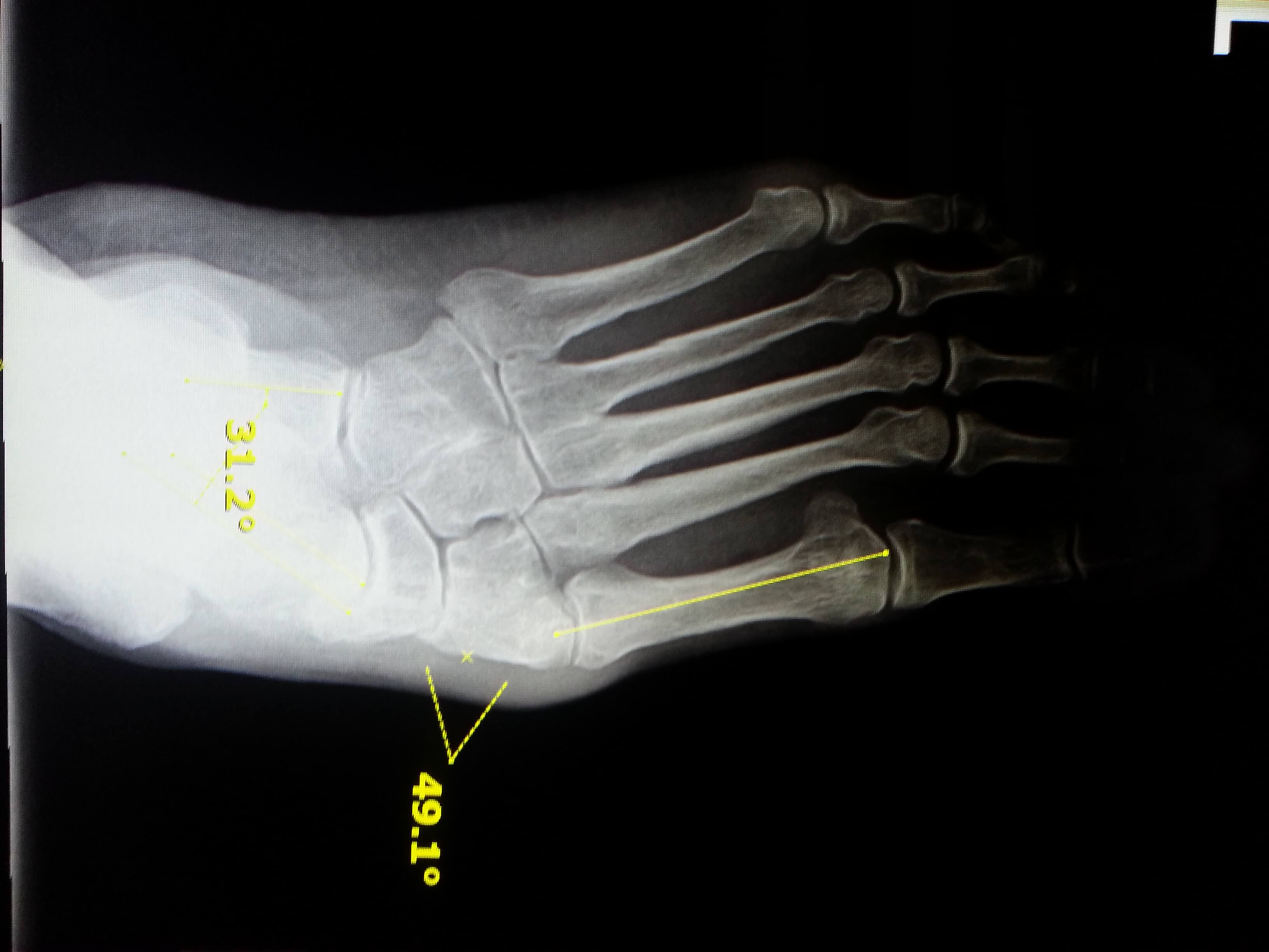 flat foot x rays Foot Doctor San Diego / La Jolla Podiatrist
