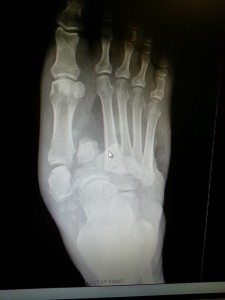 Diabetic Charcot Foot repair - Foot Doctor San Diego / La Jolla Podiatrist