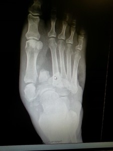 Diabetic Charcot Foot repair - Foot Doctor San Diego / La Jolla Podiatrist