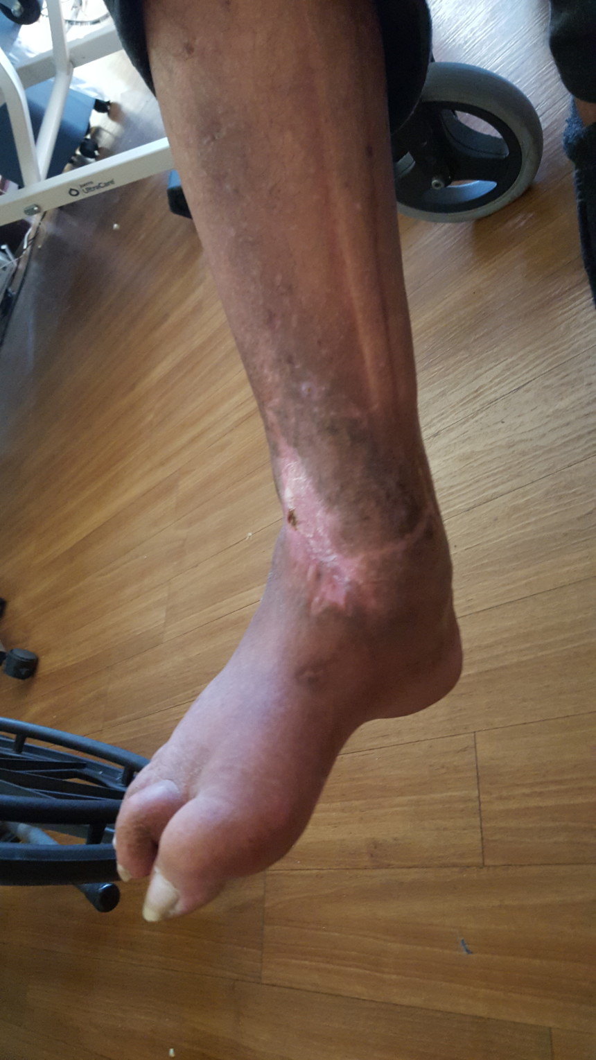 Healed ankle wound Foot Doctor San Diego / La Jolla Podiatrist