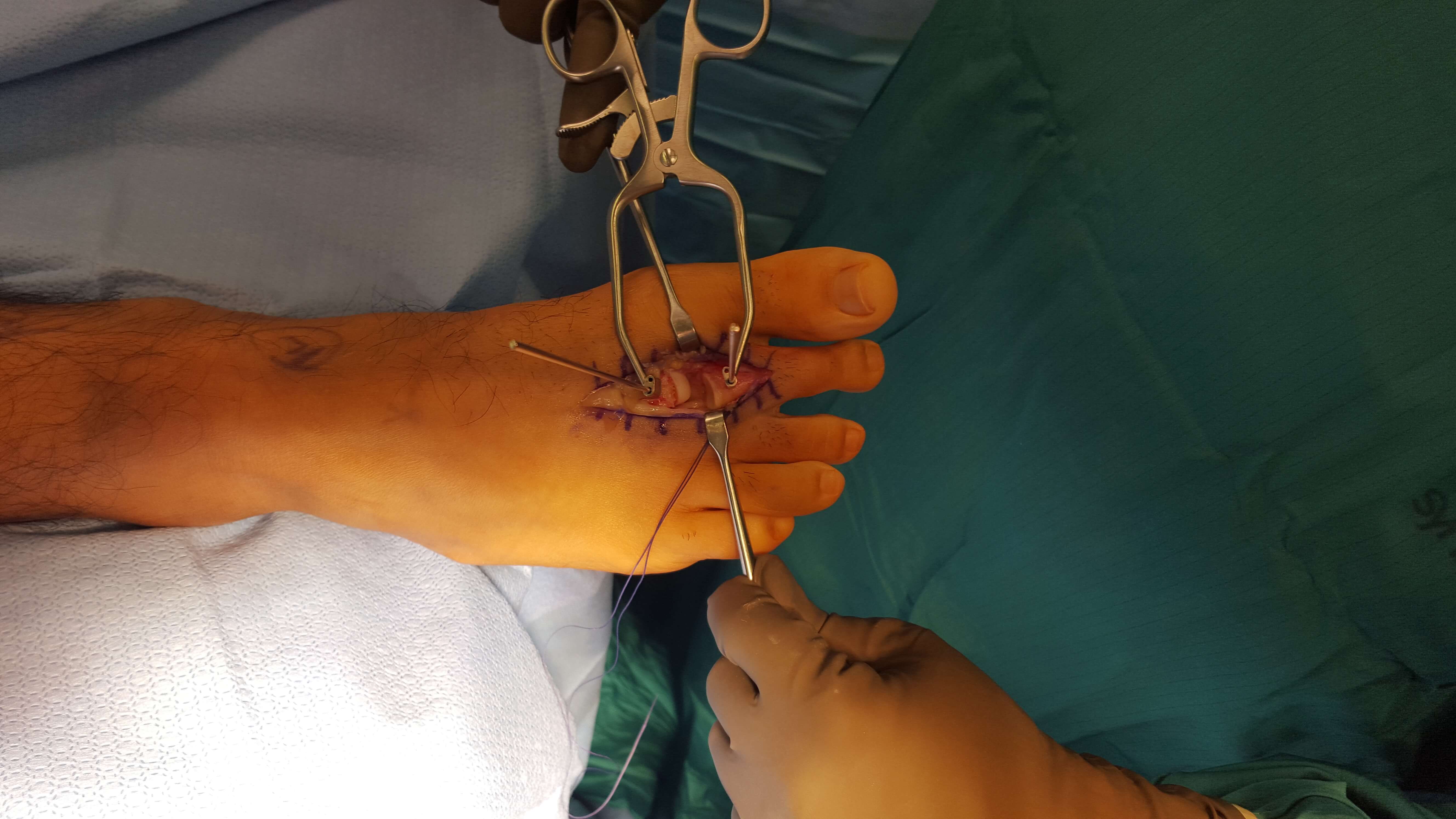 Plantar plate tear Foot Doctor San Diego / La Jolla