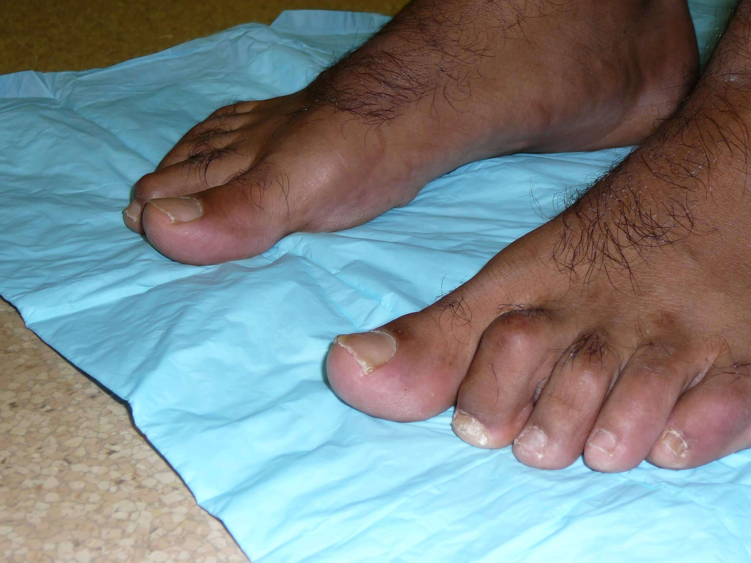 Hammertoes Foot Doctor San Diego La Jolla Podiatrist