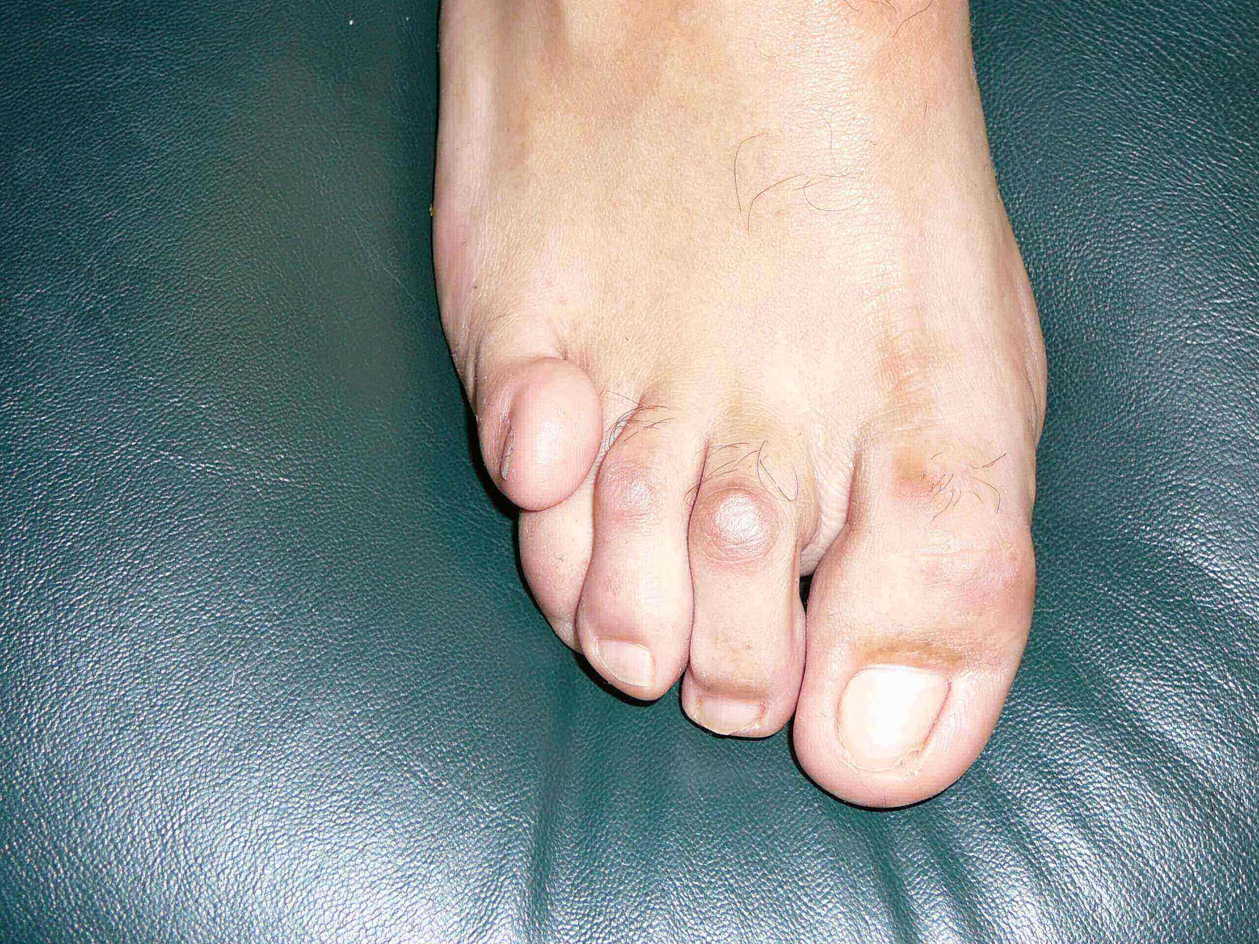 Hammertoes Foot Doctor San Diego La Jolla Podiatrist