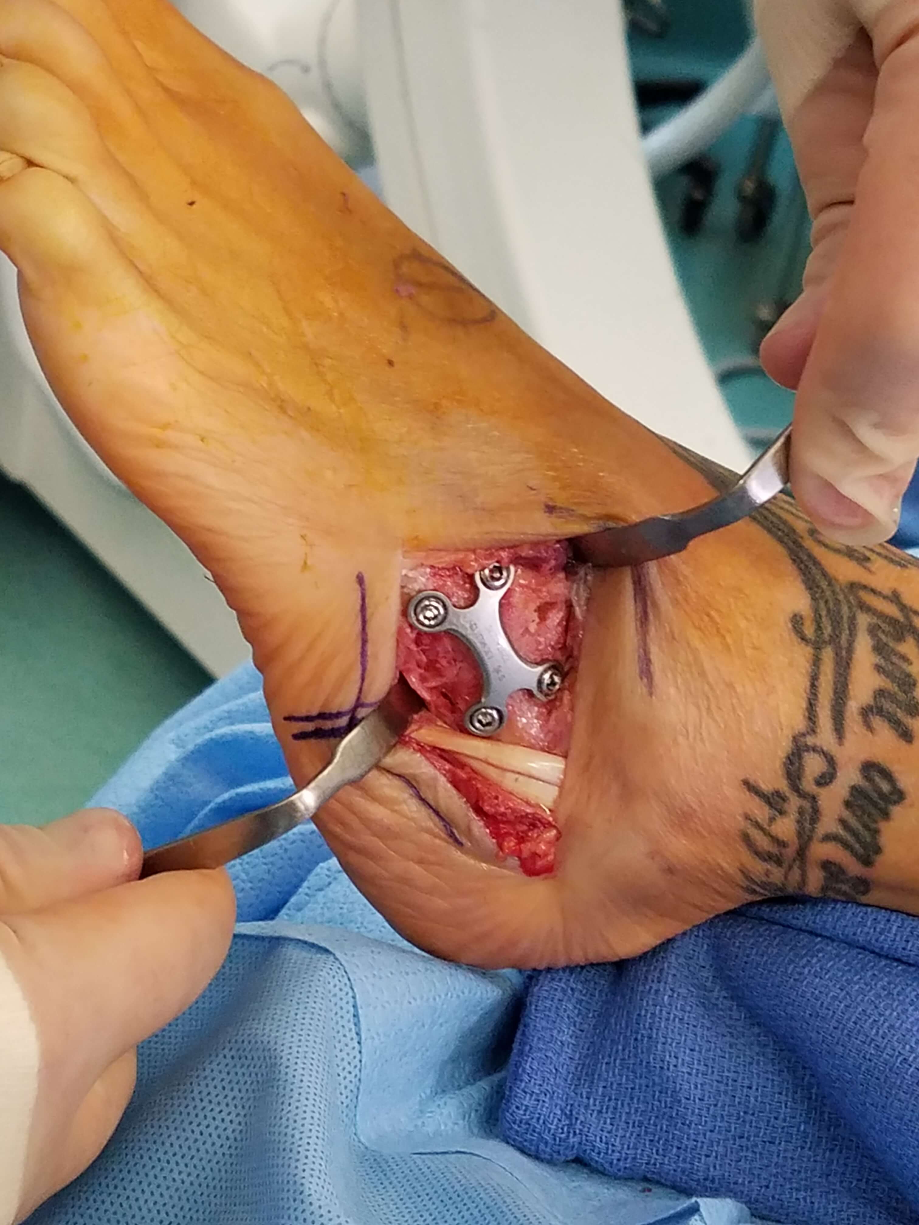 Foot Arthritis Surgery Foot Doctor San Diego / La Jolla