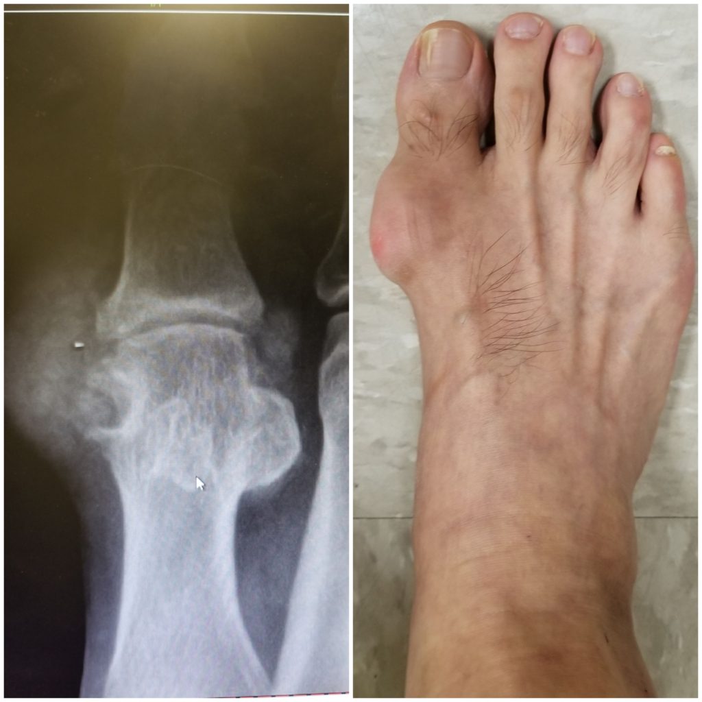 Gout Foot Doctor San Diego / La Jolla Podiatrist